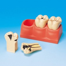 Модель из трех зубов с выделенными тремя стадиями кариеса в масштабе 5:1