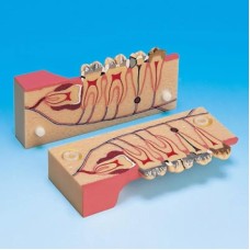 Модель с саггитальным разрезом показывающая зубы с нормальной и патологически измененной пульпой
