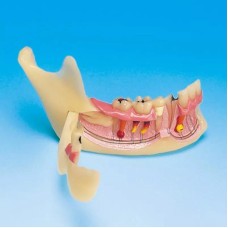 Модель половины нижней челюсти демонстрирующая осложнения кариеса